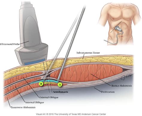 Figure From Subcostal Transverse Abdominis Plane Block For Acute Pain