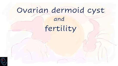 Ovarian Dermoid Cyst And Fertility Youtube