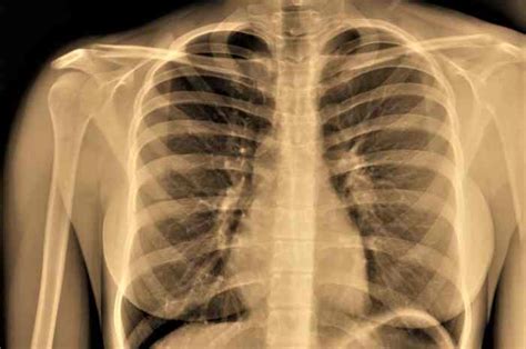 Enfisema Polmonare Cause Sintomi E Trattamento