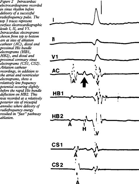 Figure 2 From TECHNIQUE Long Term Results Of Fast Pathway Ablation In