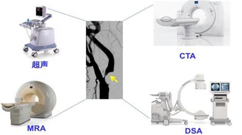技术展示 头颈部血管高分辨率血管壁成像 医院汇 丁香园