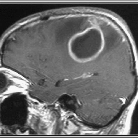 (PDF) Cerebral abscess of odontogenic origin