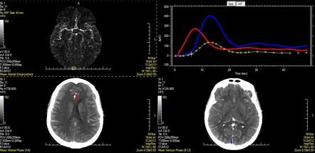 Ct Brain Perfusion Protocol Radiology Reference Article