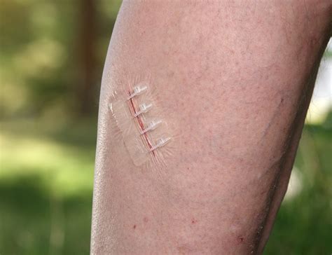 Zipstitch Is A Wound Closure Device That Works In Seconds