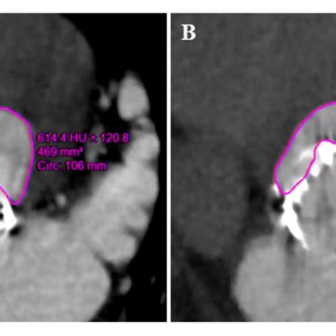 Preoperative And Postoperative Multidetector Ct In The Assessment Of