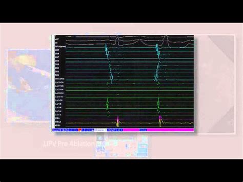 Part 5a Of 6 Cryoballoon Ablation For Atrial Fibrillation By Wilber Su Youtube