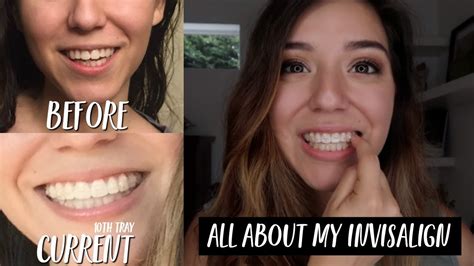 All About My Invisalign Before After Pics Cost Experience So Far