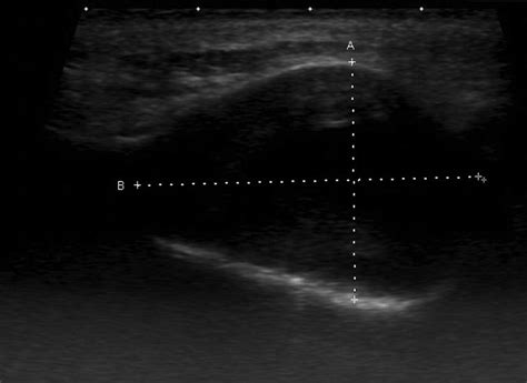 Of Ultrasonography In Maxillofacial Intraoral Inflammatory And Cystic