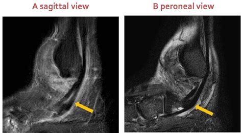 Figure 2 from Peroneal tendon pathology evaluation using the oblique ...