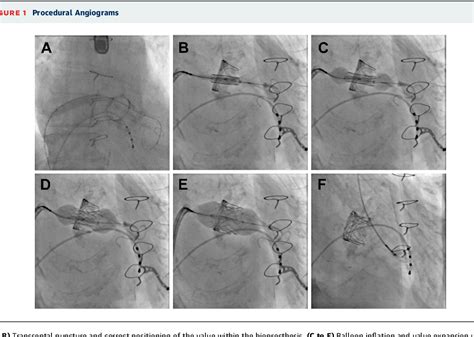 Figure 1 From Transseptal Transcatheter Implantation Of A Third