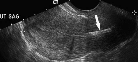 Genital Tract And Bladder Ultrasound Radiology Key