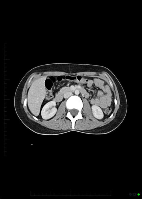 CT Scan With IV Contrast Patient Fact Sheet