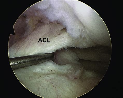 Left Knee Arthroscopic View Through Anterolateral Portal Showing