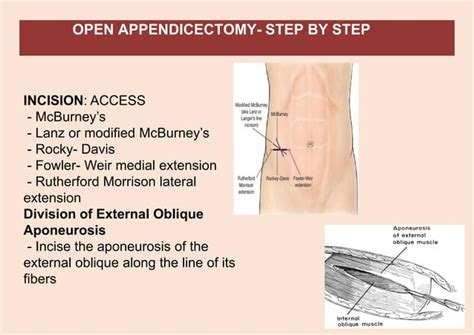 Acute Appendicitis Appendicectomy Open Laparoscopic Pdf