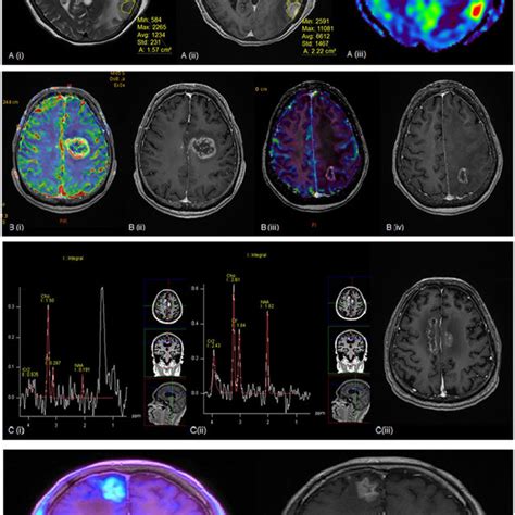 MRI scan of the brain from the brain lab, (A) at the time of the ...