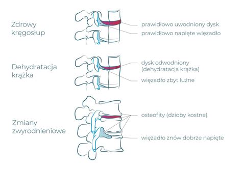 Zwyrodnienie Kr Gos Upa Objawy Przyczyny Leczenie Onsen