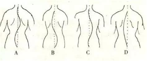 脊柱侧弯有多可怕，吓得我马上坐直了！