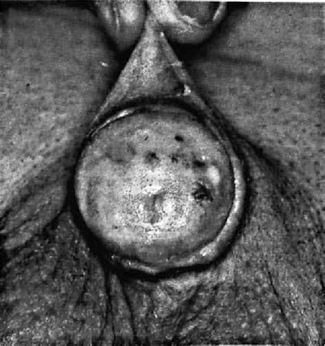 Figure 1 From Balanitis Xerotica Obliterans Involving Urethral Meatus Semantic Scholar