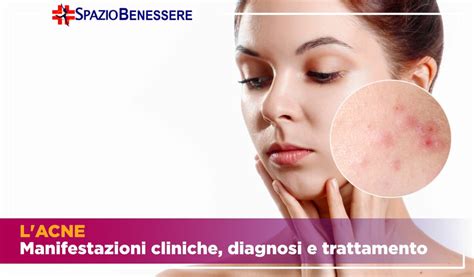 Acne Come Si Manifesta La Diagnosi E Come Si Cura