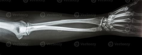 film x ray forearm AP antero posterior view 2499792 Stock Photo at Vecteezy