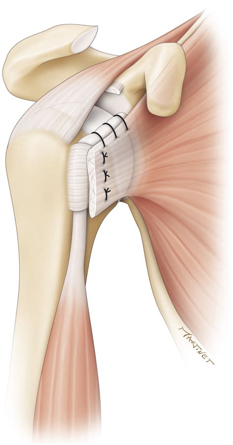 Long Head Of The Biceps Pediculated Autograft Augmentation Of