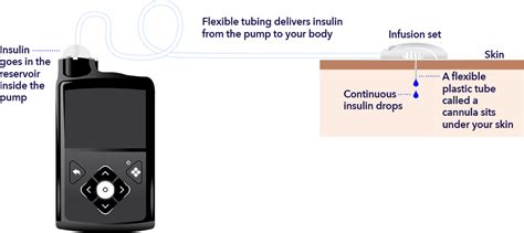 Medtronic Insulin Pump