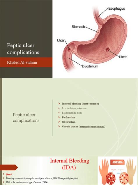 Peptic Ulcer Complications | PDF | Medicine | Health Sciences