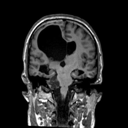 Cystic Acoustic Schwannoma Image Radiopaedia Org