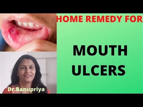 Mouth Ulcers Home Remedy Dr Banupriya Youtube