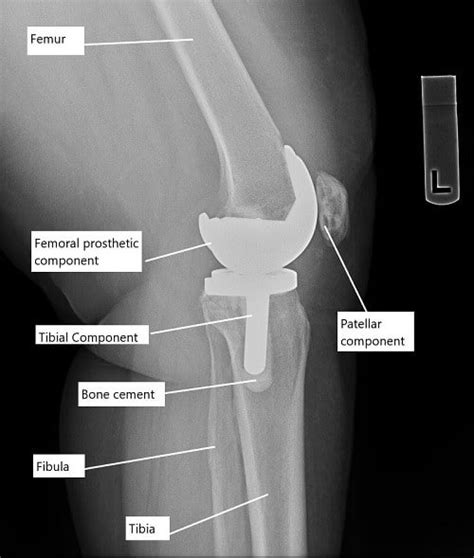 Total Knee Replacement Using Stryker Triathlon System 45 Off