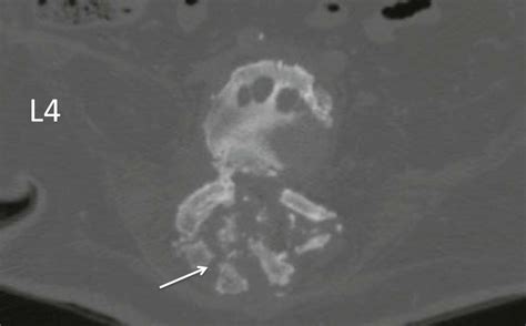 Charcot Spine Neuroarthropathy And Hip Heterotopic Ossification The Spine Journal