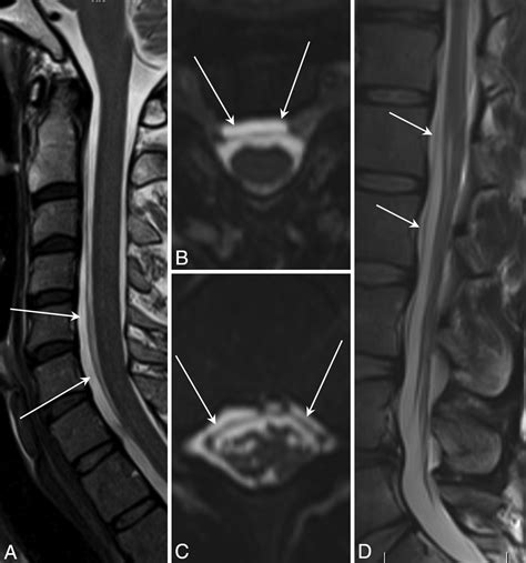 Spontaneous Intracranial Hypotension A Systematic Imaging Approach For Csf Leak Localization