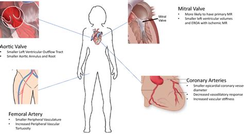 Sex Based Differences In Coronary And Structural Percutaneous Interventions PMC