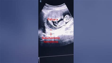 Subchorionic Hematoma Subchorionic Hemorrhage 1st Trimester