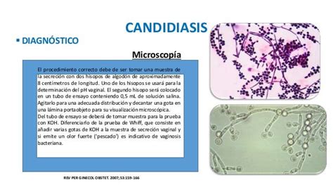 Candidiasis