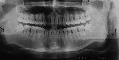 Uneven upper jaw bone? : r/askdentists