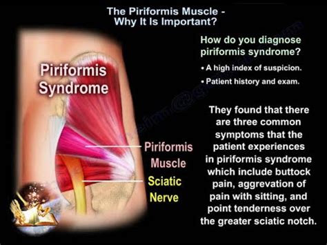 The Piriformis Syndrome Causes And Diagnosis Everything You Need To