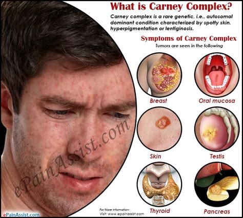 What is Carney Complex|Causes|Symptoms|Treatment|Prognosis|Pathophysiology