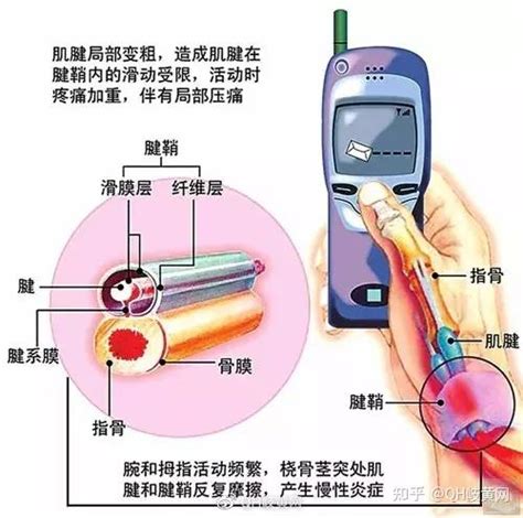 腱鞘囊肿的岐黄针治疗体会 知乎