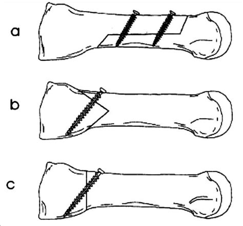 Different types of proximal metatarsal osteotomy: (a) Scarf osteotomy ...