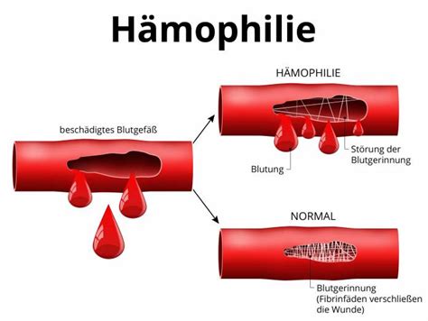 H Mophilie Ursachen Symptome Behandlung