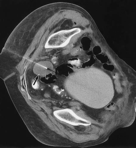 CT Guided Transgluteal Drainage Of Deep Pelvic Abscesses Indications