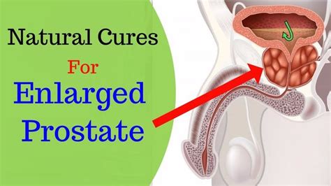 6 Effective Home Remedies To Treat Prostate Enlargement Youtube