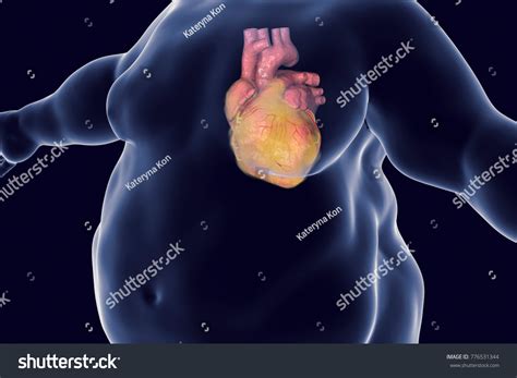 11 349 Imágenes De Obesity Heart Imágenes Fotos Y Vectores De Stock Shutterstock