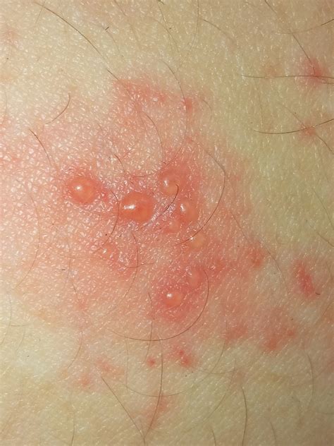 Chicken Pox In October 2020 By Nikita Gerasin Herpes Zoster · Inaturalist