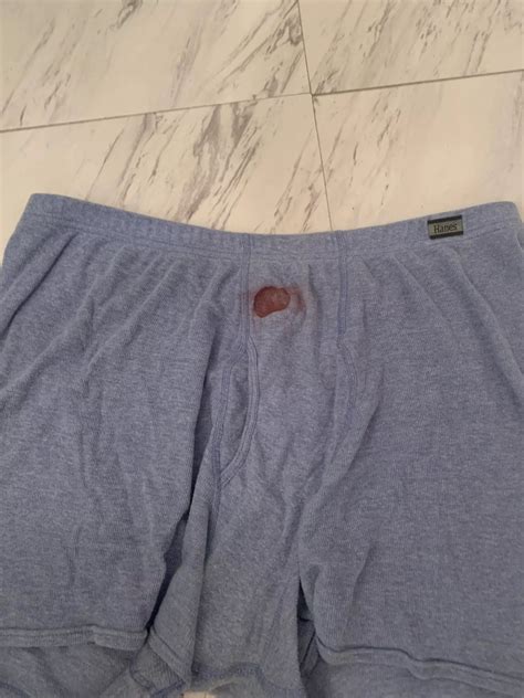 The Other Night I Had A Boil Pop In My Sleep Here Is The Aftermath Nudes Popping NUDE PICS ORG
