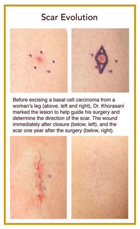 Scar Healing Raised At Rubye Wroten Blog