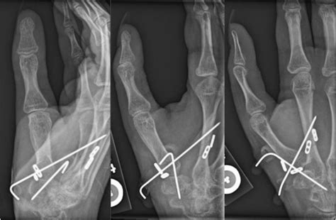 Early Thumb Carpometacarpal Subluxation Stabilized With A Mini