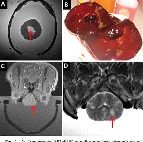 Figure 1 From Transcranial Mr Guided Focused Ultrasound