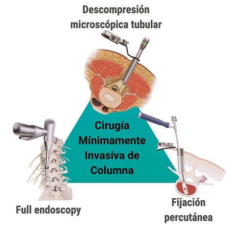 Soluciones para dolores de columna vertebral mínimamente invasivas El